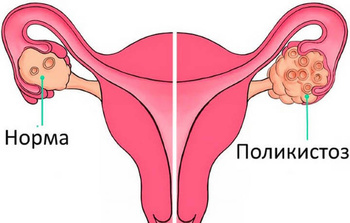Фото: признаки СПКЯ